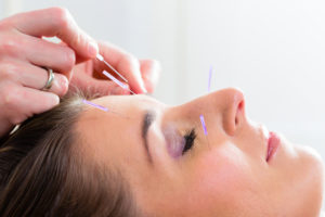 Therapist setting acupuncture needles on woman in course of acupuncture treatment
